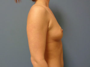 Breast Augmentation Before and After Pictures Nashville, TN