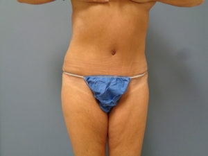 Tummy Tuck Before and After Pictures Nashville, TN