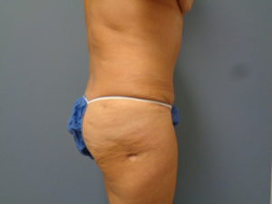 Tummy Tuck Before and After Pictures Nashville, TN