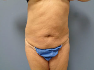 Tummy Tuck Before and After Pictures Nashville, TN