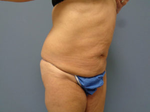 Tummy Tuck Before and After Pictures Nashville, TN