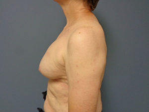 Implant Exchange/Removal Before and After Pictures Nashville, TN