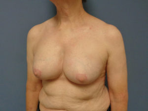 Implant Exchange/Removal Before and After Pictures Nashville, TN