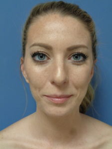 Otoplasty Before and After Pictures Nashville, TN