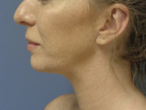 Chin Augmentation Before and After Pictures Nashville, TN