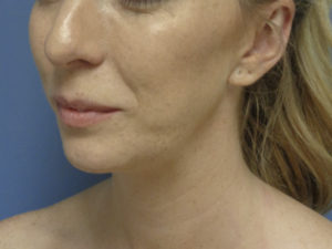 Chin Augmentation Before and After Pictures Nashville, TN