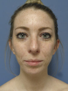 Otoplasty Before and After Pictures Nashville, TN