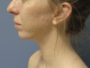 Chin Augmentation Before and After Pictures Nashville, TN