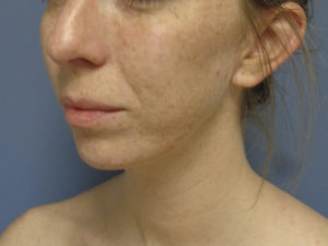 Chin Augmentation Before and After Pictures Nashville, TN