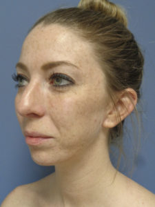 Otoplasty Before and After Pictures Nashville, TN