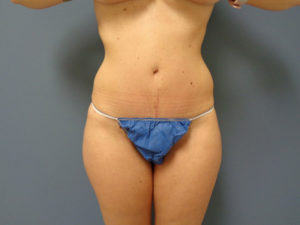 Tummy Tuck Before and After Pictures Nashville, TN