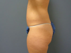 Tummy Tuck Before and After Pictures Nashville, TN