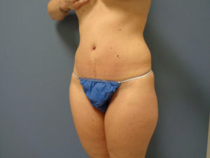 Tummy Tuck Before and After Pictures Nashville, TN