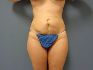 Tummy Tuck Before and After Pictures Nashville, TN