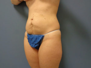 Tummy Tuck Before and After Pictures Nashville, TN