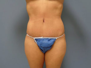 Tummy Tuck Before and After Pictures Nashville, TN