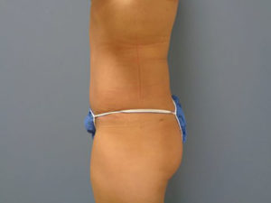 Tummy Tuck Before and After Pictures Nashville, TN