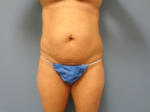 Tummy Tuck Before and After Pictures Nashville, TN