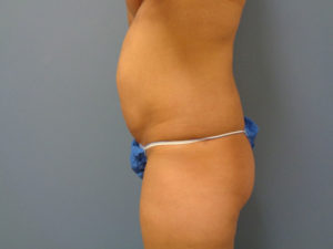 Tummy Tuck Before and After Pictures Nashville, TN