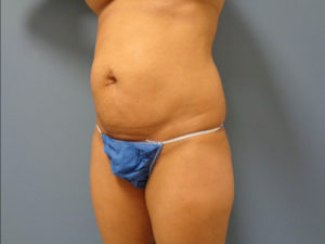 Tummy Tuck Before and After Pictures Nashville, TN