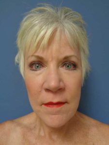 Facelift Before and After Pictures Nashville, TN