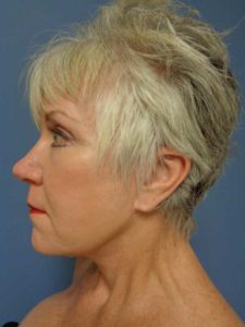 Facelift Before and After Pictures Nashville, TN