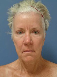 Facelift Before and After Pictures Nashville, TN