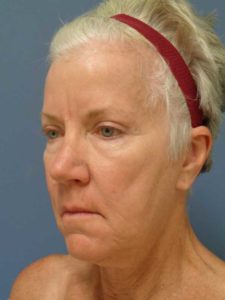 Facelift Before and After Pictures Nashville, TN