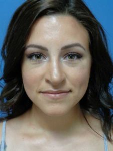 Rhinoplasty Before and After Pictures Nashville, TN