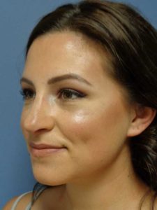 Rhinoplasty Before and After Pictures Nashville, TN