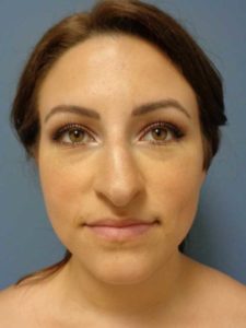 Rhinoplasty Before and After Pictures Nashville, TN