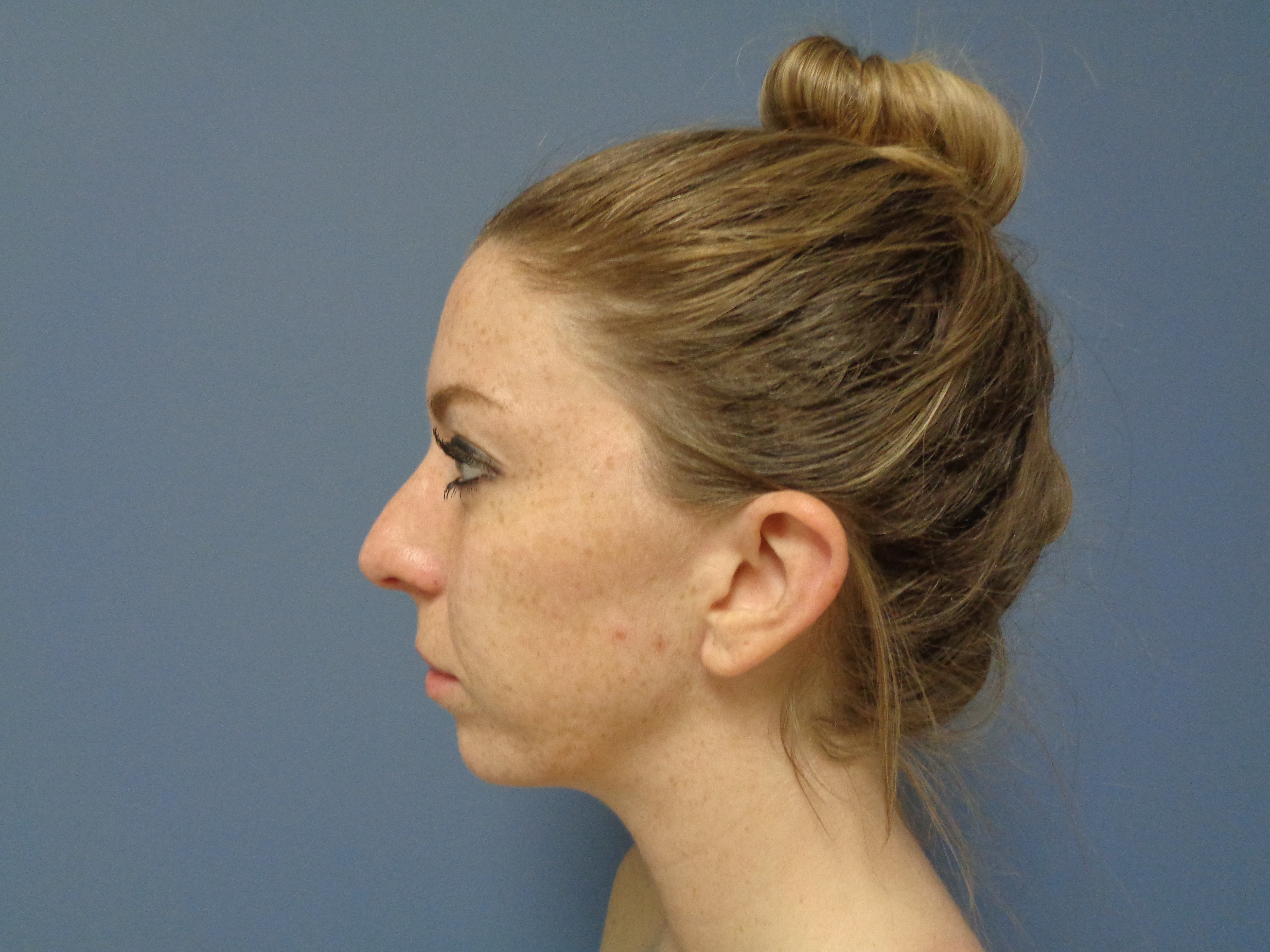 chin augmentation, blog, robbins plastic surgery