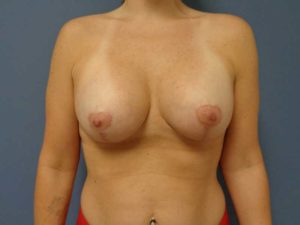 Breast Augmentation with Lift Before and After Pictures Nashville, TN