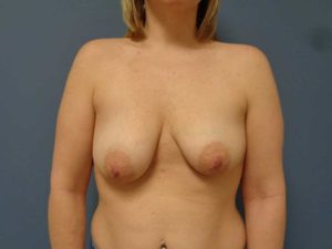 Breast Augmentation with Lift Before and After Pictures Nashville, TN