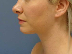 Chin Augmentation Before and After Pictures Nashville, TN