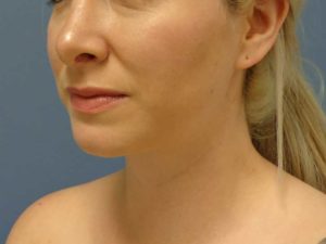 Chin Augmentation Before and After Pictures Nashville, TN