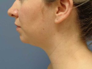 Chin Augmentation Before and After Pictures Nashville, TN
