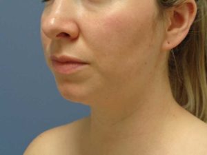 Chin Augmentation Before and After Pictures Nashville, TN