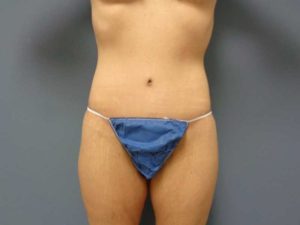 Tummy Tuck Before and After Pictures Nashville, TN