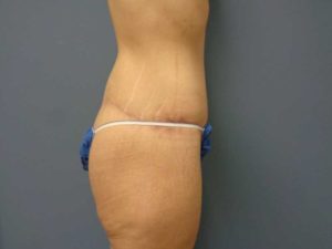 Tummy Tuck Before and After Pictures Nashville, TN