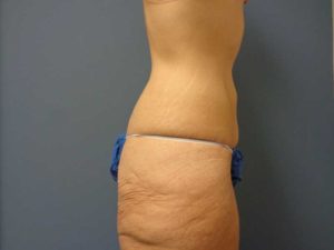 Tummy Tuck Before and After Pictures Nashville, TN