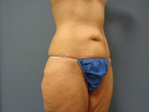 Tummy Tuck Before and After Pictures Nashville, TN