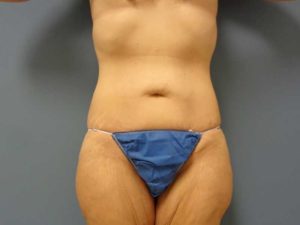 Tummy Tuck Before and After Pictures Nashville, TN