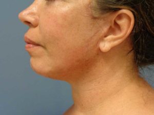 Chin Augmentation Before and After Pictures Nashville, TN