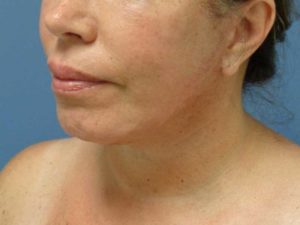 Chin Augmentation Before and After Pictures Nashville, TN