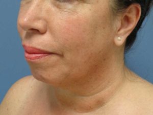 Chin Augmentation Before and After Pictures Nashville, TN