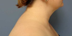 Liposuction Before & After Pictures in Nashville, TN