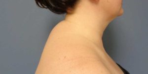 Liposuction Before & After Pictures in Nashville, TN