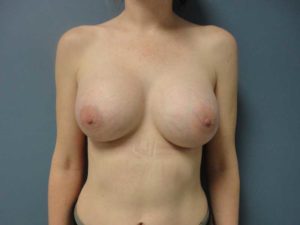 Before & After Pictures in Nashville, TN