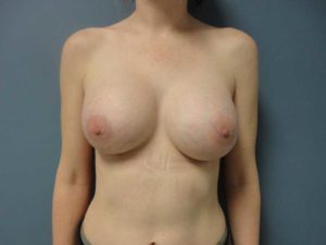 Breast Augmentation Before & After Pictures in Nashville, TN